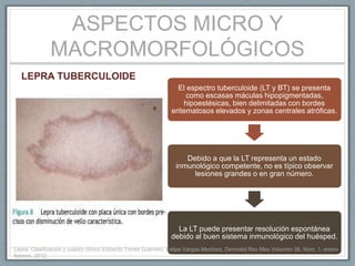 ASPECTOS MICRO Y
MACROMORFOLÓGICOS
LEPRA TUBERCULOIDE
El espectro tuberculoide (LT y BT) se presenta
como escasas máculas hipopigmentadas,
hipoestésicas, bien delimitadas con bordes
eritematosos elevados y zonas centrales atróficas.
Debido a que la LT representa un estado
inmunológico competente, no es típico observar
lesiones grandes o en gran número.
La LT puede presentar resolución espontánea
debido al buen sistema inmunológico del huésped.
Lepra. Clasificación y cuadro clínico Edoardo Torres Guerrero, Felipe Vargas Martínez, Dermatol Rev Mex Volumen 56, Núm. 1, enero-
febrero, 2012.
 