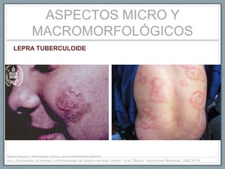 ASPECTOS MICRO Y
MACROMORFOLÓGICOS
LEPRA TUBERCULOIDE
Nava-Segura J. Neurología clínica, sus fundamentos anatómi-
cos y funcionales, síndromes y enfermedades del sistema nervioso central. 1a ed. México: Impresiones Modernas, 1968;34-38.
 