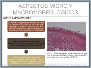 ASPECTOS MICRO Y
MACROMORFOLÓGICOS
LEPRA LEPROMATOSA
El espectro categórico lepromatoso (LL y BL)
se caracte- riza por pápulas y nódulos que
confluyen, pudiendo originar una marcada
infiltración difusa de la piel que da lugar a la
denominada facies leonina y a la madarosis.
Las lesiones suelen ser simétricas y
bilaterales. En etapas tempranas la piel suele
tener una apariencia infiltrada y cérea.
En esta polaridad suele haber más
afectación nerviosa e incapacidad que en la
tuberculoide. Existen dos variedades clínicas
de la LL, que son la nodular y la difusa
Lepra. Clasificación y cuadro clínico Edoardo Torres Guerrero, Felipe Vargas Martínez, Dermatol Rev Mex Volumen 56, Núm. 1, enero-
febrero, 2012.
 