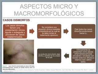 ASPECTOS MICRO Y
MACROMORFOLÓGICOS
Los casos dimorfos
tienen una
presentación clínica
aguda o subaguda y
provienen de casos
indeterminados.
Se considera una
situación clínica inestable
y transitoria en la cual se
le debe iniciar el
tratamiento oportuno.
Casi todos los casos
dimorfos evolucionan
hacia LL.
Clínicamente se
presentan como placas
eritematoescamosas
circulares o anulares con
bordes externos difusos e
internos bien delimi-
tados.
La evolución de la lesión deja
atrofia y pérdida de los anejos
de la piel.
CASOS DISMORFOS
Lepra. Clasificación y cuadro clínico Edoardo Torres Guerrero, Felipe Vargas Martínez, Dermatol Rev Mex Volumen 56, Núm. 1, enero-
febrero, 2012.
 