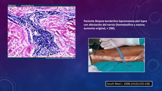 Paciente Biopsia borderline lepromatosa piel lepra 
con afectación del nervio (hematoxilina y eosina; 
aumento original, × 200). 
South Med J. 2008;101(6):635-638. 
 