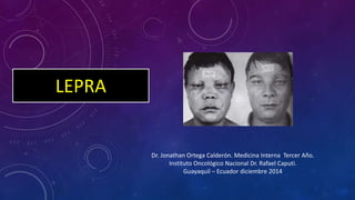 LEPRA 
Dr. Jonathan Ortega Calderón. Medicina Interna Tercer Año. 
Instituto Oncológico Nacional Dr. Rafael Caputi. 
Guayaquil – Ecuador diciembre 2014 
 