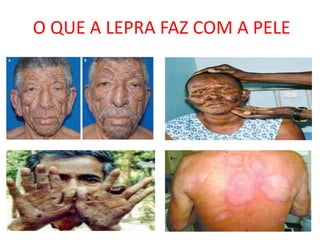 O QUE A LEPRA FAZ COM A PELE
 