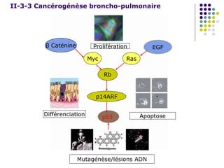II-3-3 Cancérogénèse broncho-pulmonaire
β Caténine EGF
Rb
p14ARF
p53
RasMyc
Prolifération
Différenciation Apoptose
Mutagénèse/lésions ADN
 