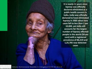 It is nearly 11 years since
leprosy was officially
declared eliminated as a
public health concern in
India. India was officially
declared to have eliminated
leprosy in 2005 when new
cases fell to less than 1 per
10,000, yet India still
accounts for the largest
number of leprosy affected
people in the world (58 per
cent) with a registered
prevalence of 86,319 and
1,25,785 new detected
cases
Attribution-NonCommercial-ShareAlike 4.0 International (CC BY-NC-SA 4.0)
 