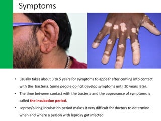 • usually takes about 3 to 5 years for symptoms to appear after coming into contact
with the bacteria. Some people do not develop symptoms until 20 years later.
• The time between contact with the bacteria and the appearance of symptoms is
called the incubation period.
• Leprosy's long incubation period makes it very difficult for doctors to determine
when and where a person with leprosy got infected.
Symptoms
 