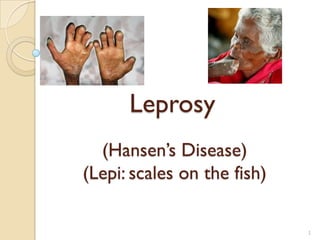 Leprosy
(Hansen’s Disease)
(Lepi: scales on the fish)
1

 