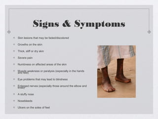 Signs & Symptoms
Skin lesions that may be faded/discolored
Growths on the skin
Thick, stiff or dry skin
Severe pain
Numbness on affected areas of the skin
Muscle weakness or paralysis (especially in the hands
and feet)
Eye problems that may lead to blindness
Enlarged nerves (especially those around the elbow and
knee)
A stuffy nose
Nosebleeds
Ulcers on the soles of feet