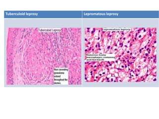 Tuberculoid leprosy Lepromatous leprosy
 
