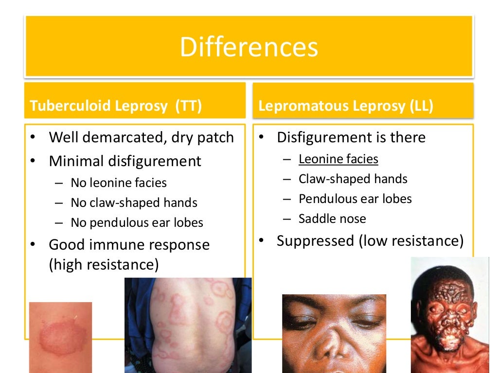 leprosy