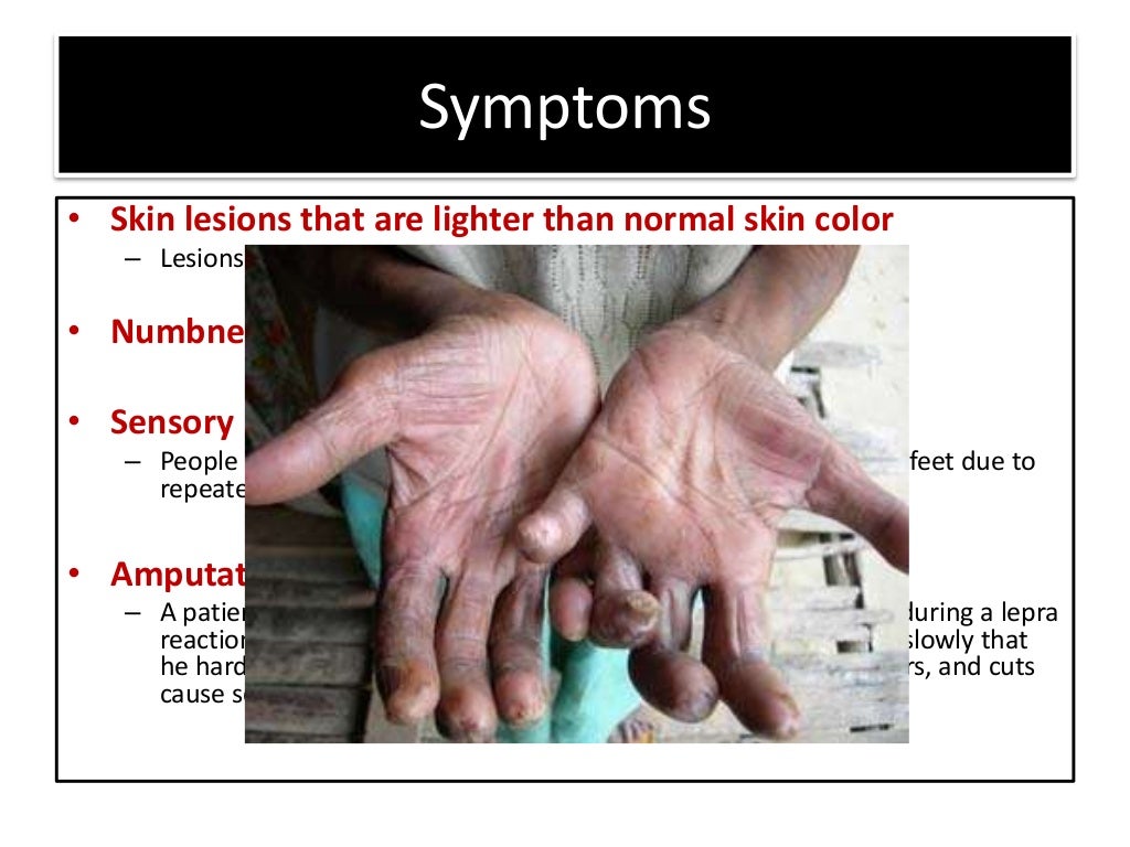 Leprosy