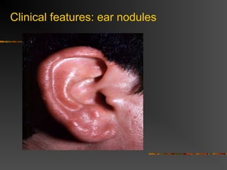Clinical features: ear nodules