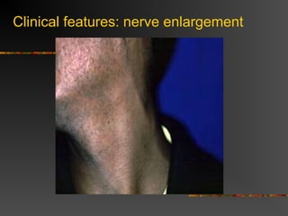 Clinical features: nerve enlargement