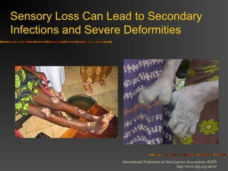 International Federation of Anti-Leprosy Associations (ILEP)
http://www.ilep.org.uk/en/
Sensory Loss Can Lead to Secondary
Infections and Severe Deformities
 