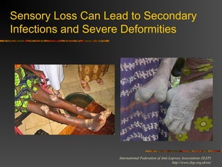 International Federation of Anti-Leprosy Associations (ILEP)
http://www.ilep.org.uk/en/
Sensory Loss Can Lead to Secondary...