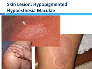 Skin Lesion: Hypopigmented
Hypoesthesia Maculae
 