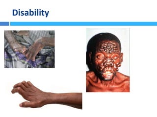Disability
 