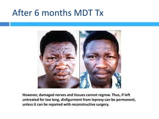 After 6 months MDT Tx
However, damaged nerves and tissues cannot regrow. Thus, if left
untreated for too long, disfigurment from leprosy can be permanent,
unless it can be repaired with reconstructive surgery.
 