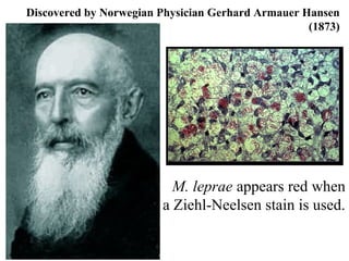 Discovered by Norwegian Physician Gerhard Armauer Hansen
(1873)
M. leprae appears red when
a Ziehl-Neelsen stain is used.
 