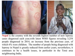 Nepal is the country with the seventh highest number of new leprosy
cases diagnosed each year,with latest WHO figures revealing 3,254
people diagnosed in 2014, an increase from the previous year, of
which 6% were children. The number of people being diagnosed with
leprosy in Nepal is greatly reduced from earlier years, nevertheless, it
continues to be a health issues, in particular in the Terai area
neighbouring India.
 