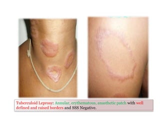 Tuberculoid Leprosy: Annular, erythematous, anasthetic patch with well
defined and raised borders and SSS Negative.
 