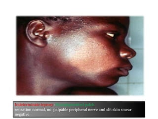 Indeterminate leprosy :Hypopigmented patch
sensation normal, no palpable peripheral nerve and slit skin smear
negative
 