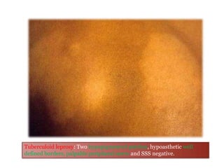 Tuberculoid leprosy: Two hypopigmented patches, hypoasthetic well
defined borders, palpable peripheral nerve and SSS negative.
 