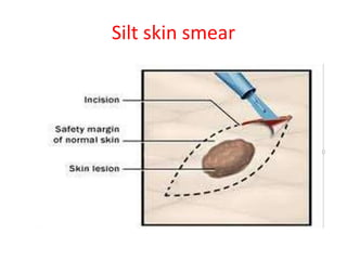Silt skin smear
 