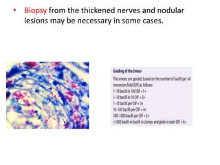 • Biopsy from the thickened nerves and nodular
lesions may be necessary in some cases.
 