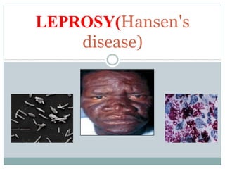LEPROSY(Hansen's
disease)
 