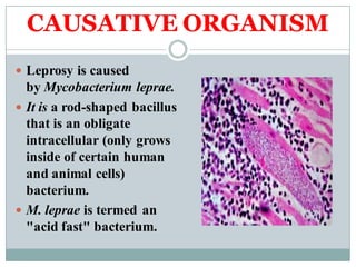 CAUSATIVE ORGANISM
 Leprosy is caused
by Mycobacterium leprae.
 It is a rod-shaped bacillus
that is an obligate
intracellular (only grows
inside of certain human
and animal cells)
bacterium.
 M. leprae is termed an
"acid fast" bacterium.
 