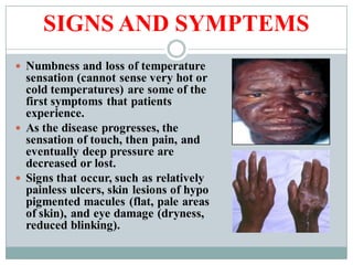SIGNS AND SYMPTEMS
 Numbness and loss of temperature
sensation (cannot sense very hot or
cold temperatures) are some of the
first symptoms that patients
experience.
 As the disease progresses, the
sensation of touch, then pain, and
eventually deep pressure are
decreased or lost.
 Signs that occur, such as relatively
painless ulcers, skin lesions of hypo
pigmented macules (flat, pale areas
of skin), and eye damage (dryness,
reduced blinking).
 