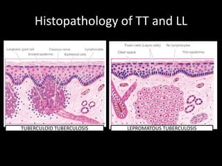 Histopathology of TT and LL
TUBERCULOID TUBERCULOSIS LEPROMATOUS TUBERCULOSIS
 