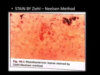 • STAIN BY Ziehl – Neelsen Method
 