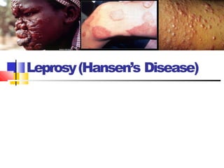 Leprosy(Hansen’s Disease)
 