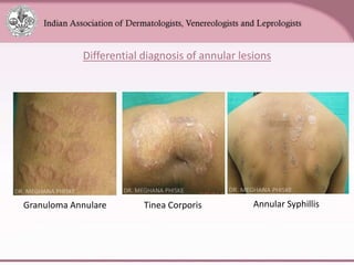 LEPROSY dermatology microbiology - hansen | PPTX