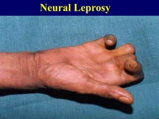 Neural Leprosy
 