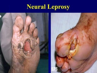 Neural Leprosy
 
