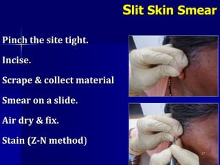Pinch the site tight.
Incise.
Scrape & collect material
Smear on a slide.
Air dry & fix.
Stain (Z-N method)
17
Slit Skin Smear
 