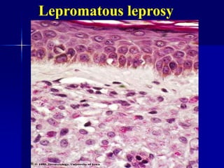 Lepromatous leprosy
 