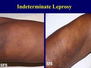 Indeterminate Leprosy
 