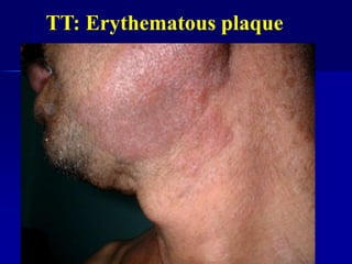 TT: Erythematous plaque
 
