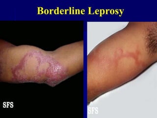 Borderline Leprosy
 