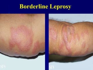 Borderline Leprosy
 
