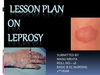 LESSON PLAN
ON
LEPROSY
SUBMITTED BY
MANU MEHTA
ROLL NO – 16
BASIC B.SC NURSING
2ndYEAR
 