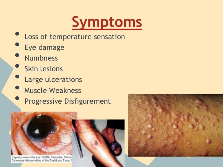 Signs Of A Bad Transmission >> Leprosy awareness james and arnav Signs Of A Bad Transmission >> Leprosy awareness james and arnav