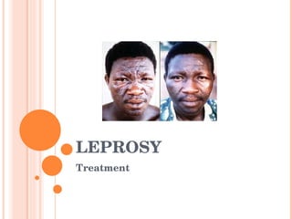 LEPROSY
Treatment
 