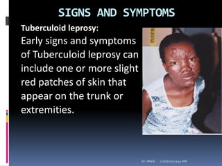 SIGNS AND SYMPTOMS
Tuberculoid leprosy:
Early signs and symptoms
of Tuberculoid leprosy can
include one or more slight
red patches of skin that
appear on the trunk or
extremities.
12/16/20129:55 AMDr. Alteib
 