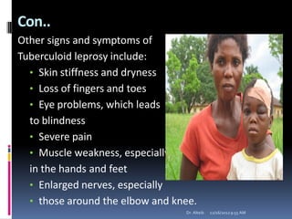 Con..
Other signs and symptoms of
Tuberculoid leprosy include:
• Skin stiffness and dryness
• Loss of fingers and toes
• Eye problems, which leads
to blindness
• Severe pain
• Muscle weakness, especially
in the hands and feet
• Enlarged nerves, especially
• those around the elbow and knee.
12/16/20129:55 AMDr. Alteib
 