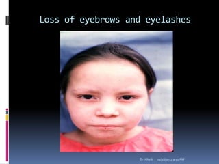Loss of eyebrows and eyelashes
12/16/20129:55 AMDr. Alteib
 